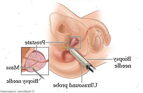Prostata biopsi. Blødning på biopsi nettstedet. Prostata biopsi. Blødning på biopsi nettstedet.
