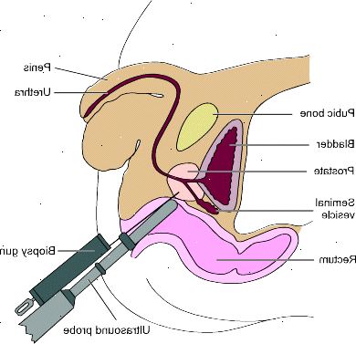 Problemer med vannlating. Typer av prostata biopsi prosedyrer. Problemer med vannlating. Typer av prostata biopsi prosedyrer.