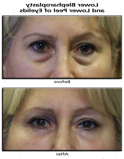 Blepharoplasty. Din medisinske historie. Blepharoplasty. Din medisinske historie.