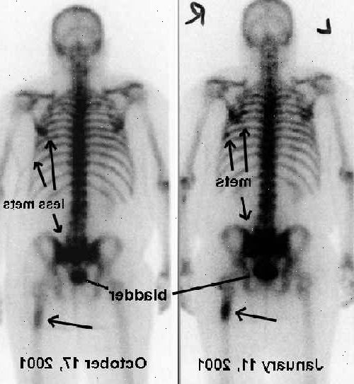 Bone scan. Injeksjonen. Bone scan. Injeksjonen.