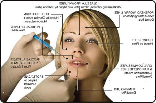 Botox-injeksjoner. Cervikal dystoni. Botox-injeksjoner. Cervikal dystoni.