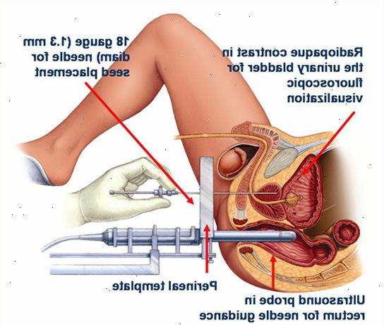 Stråling inn i kroppens vev. Høydose rente vs Low-dose brakyterapi. Stråling inn i kroppens vev. Høydose rente vs Low-dose brakyterapi.