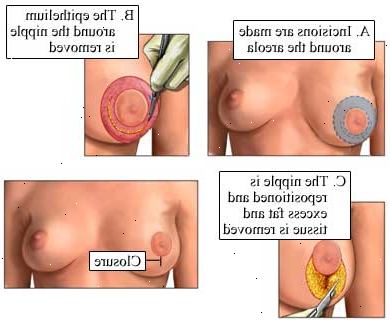 Brystreduksjon. I løpet av prosedyren. Brystreduksjon. I løpet av prosedyren.