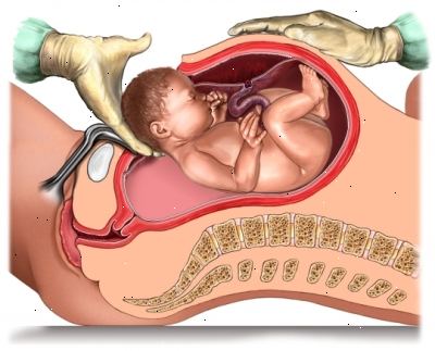 Babyen er ikke får nok oksygen. Babyen er i en unormal posisjon. Babyen er ikke får nok oksygen. Babyen er i en unormal posisjon.