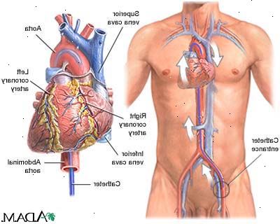 Hjertekateterisering. Angioplastikk med eller uten stent. Hjertekateterisering. Angioplastikk med eller uten stent.