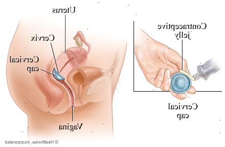 Cervical cap. Sjekk plasseringen av livmorhalsen din før du setter inn cervical cap. Cervical cap. Sjekk plasseringen av livmorhalsen din før du setter inn cervical cap.