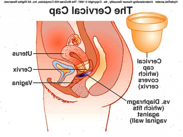 Sett cervical cap. Sjekk alltid cervical cap posisjon før sex. Sett cervical cap. Sjekk alltid cervical cap posisjon før sex.