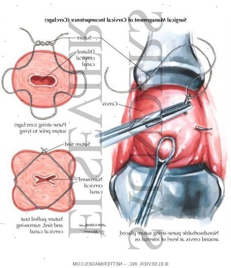 Cervical cerclage. I løpet av prosedyren. Cervical cerclage. I løpet av prosedyren.