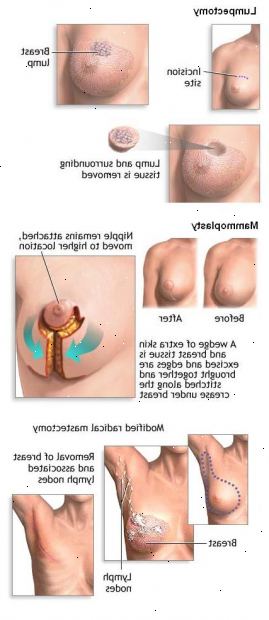 Kjemoterapi før kirurgi for. Kjemoterapi som primærbehandling for avansert brystkreft. Kjemoterapi før kirurgi for. Kjemoterapi som primærbehandling for avansert brystkreft.