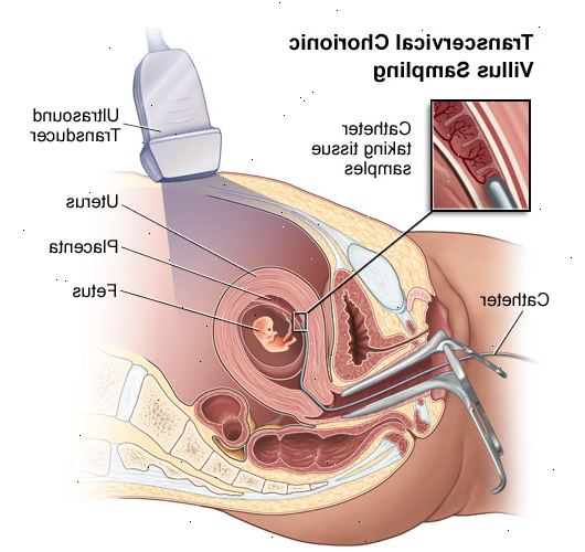 Chorionic villus prøvetaking. Du hadde positive resultater fra en prenatal screening test. Chorionic villus prøvetaking. Du hadde positive resultater fra en prenatal screening test.