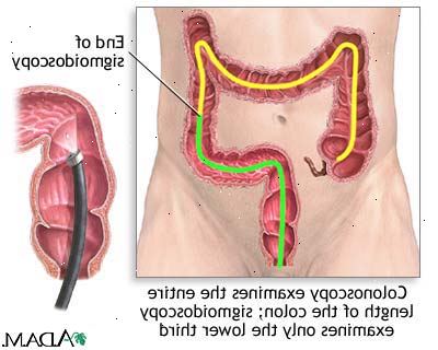 Koloskopi. Undersøke intestinal tegn og symptomer. Koloskopi. Undersøke intestinal tegn og symptomer.