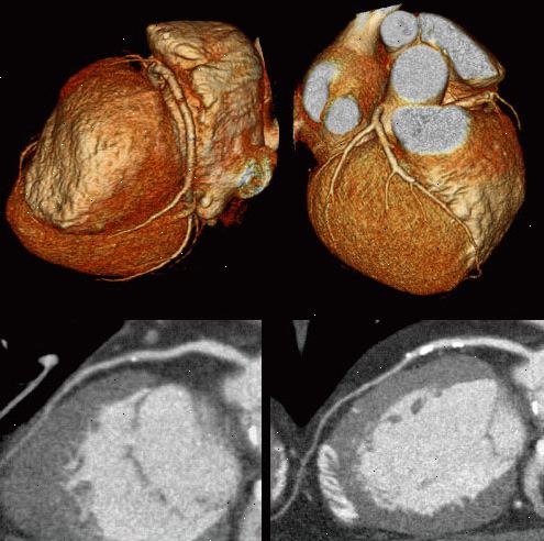 CT angiografi. I løpet av prosedyren. CT angiografi. I løpet av prosedyren.