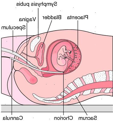 Cordocentesis. Demping av babyens hjertefrekvens. Cordocentesis. Demping av babyens hjertefrekvens.