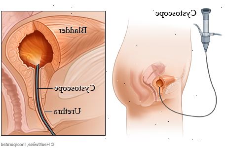 Cystoskopi. Gransker årsakene til blære tegn og symptomer. Cystoskopi. Gransker årsakene til blære tegn og symptomer.