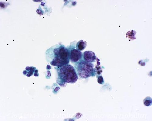 Urin cytologi. Samle en urinprøve for testing. Urin cytologi. Samle en urinprøve for testing.