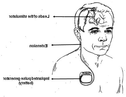 Dyp hjernestimulering. Mulige bivirkninger av stimulering. Dyp hjernestimulering. Mulige bivirkninger av stimulering.