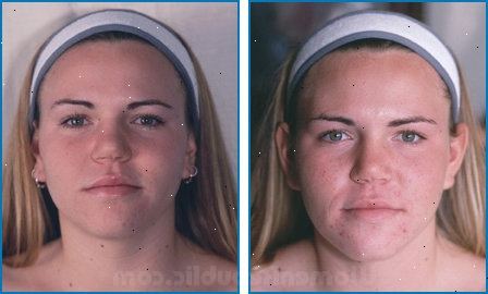 Dermabrasion. Rødhet og hevelse. Dermabrasion. Rødhet og hevelse.