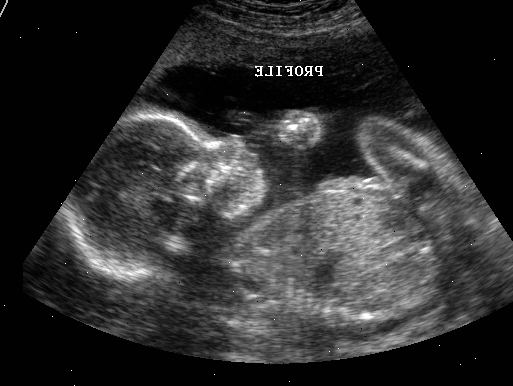 Ultralyd. Transesophageal ekkokardiogram. Ultralyd. Transesophageal ekkokardiogram.