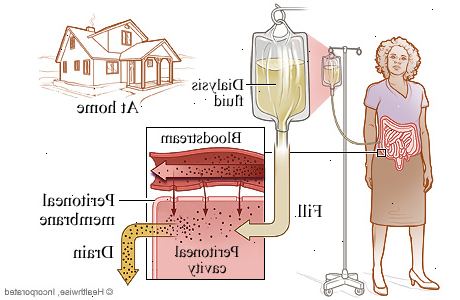 Peritonealdialyse. Svekkelse av magemusklene (brokk). Peritonealdialyse. Svekkelse av magemusklene (brokk).