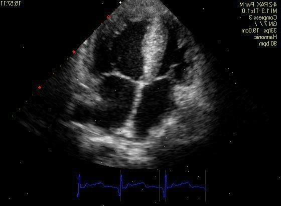 Ekkokardiogram. Transtorakal ekkokardiogram. Ekkokardiogram. Transtorakal ekkokardiogram.