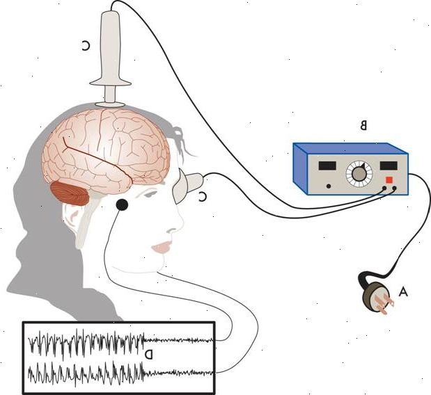 Elektrokonvulsiv terapi (ECT). Behandlingsresistent depresjon. Elektrokonvulsiv terapi (ECT). Behandlingsresistent depresjon.