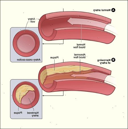 Angina. Kjennetegn på stabil angina. Angina. Kjennetegn på stabil angina.
