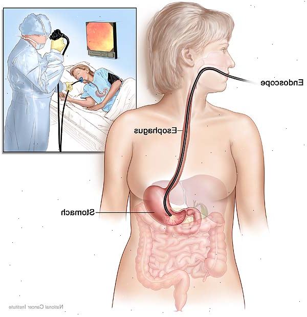 Øvre endoskopi. Undersøke symptomer. Øvre endoskopi. Undersøke symptomer.
