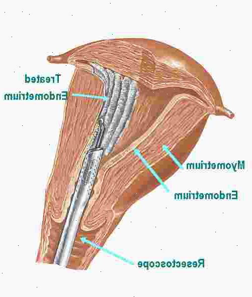 Endometrial ablasjon. Tynne endometrium. Endometrial ablasjon. Tynne endometrium.