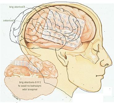Epilepsi kirurgi. Fjerning av en del av hjernen. Epilepsi kirurgi. Fjerning av en del av hjernen.