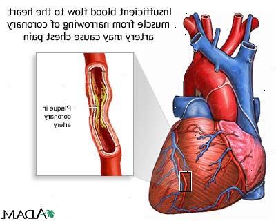 Forberedelser til din avtale. Kjennetegn på ustabil angina (et medisinsk nødstilfelle). Forberedelser til din avtale. Kjennetegn på ustabil angina (et medisinsk nødstilfelle).