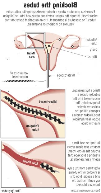 Essure. I løpet av prosedyren. Essure. I løpet av prosedyren.