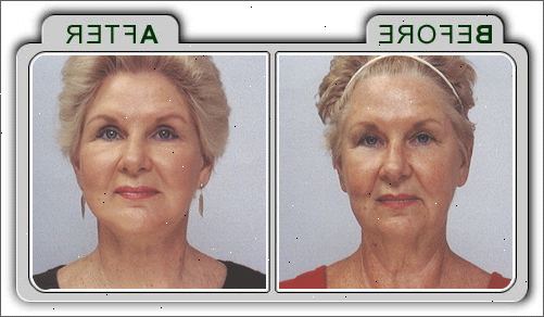 Face-lift. Hevelse og blåmerker. Face-lift. Hevelse og blåmerker.