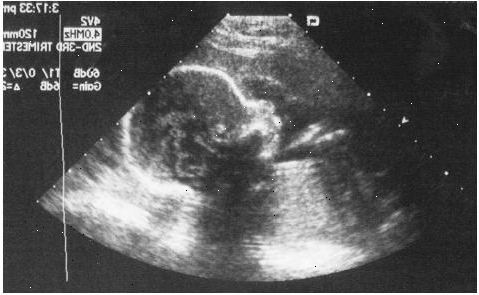 Fetal ultralyd. Bekrefte graviditeten og dens plassering. Fetal ultralyd. Bekrefte graviditeten og dens plassering.