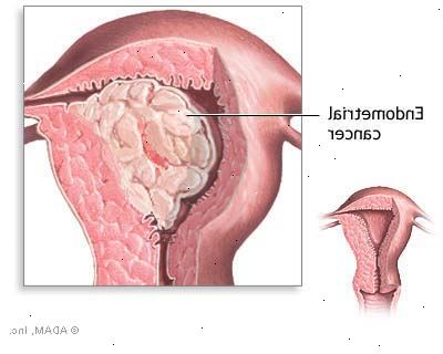 Hormon terapi for brystkreft. Tamoxifen. Hormon terapi for brystkreft. Tamoxifen.