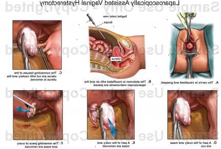 Vaginal hysterektomi. Unormal vaginal blødning. Vaginal hysterektomi. Unormal vaginal blødning.