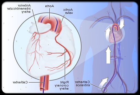 Koronar angiografi. I løpet av prosedyren. Koronar angiografi. I løpet av prosedyren.