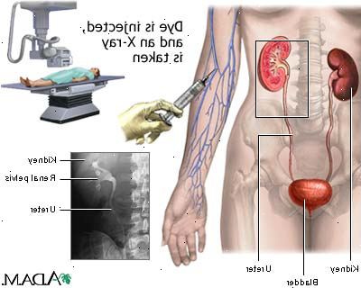 Intravenøs pyelogram. Under intravenøs pyelogram. Intravenøs pyelogram. Under intravenøs pyelogram.