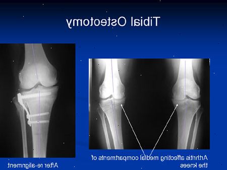 Knee osteotomi. Definisjon. Knee osteotomi. Definisjon.