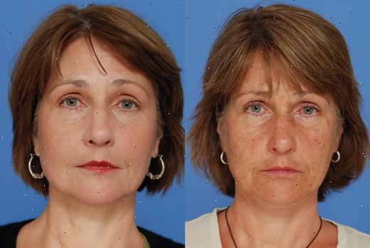 Laser resurfacing. Kløe, hevelse og rødhet. Laser resurfacing. Kløe, hevelse og rødhet.