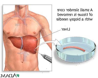 Leveren biopsi. Ulykkesskade til en nærliggende organ. Leveren biopsi. Ulykkesskade til en nærliggende organ.