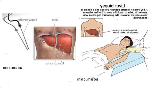 Innsamling av blod (hematom) i nakken. Midlertidige problemer med ansikts nerver. Innsamling av blod (hematom) i nakken. Midlertidige problemer med ansikts nerver.