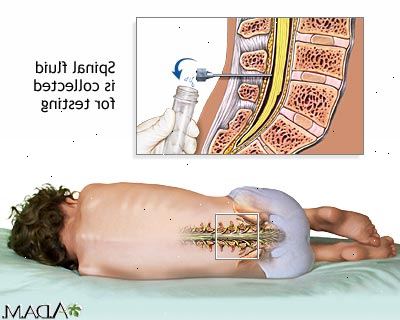 Spinalpunksjon (Spinal Tap). Post-spinalpunksjon hodepine. Spinalpunksjon (Spinal Tap). Post-spinalpunksjon hodepine.