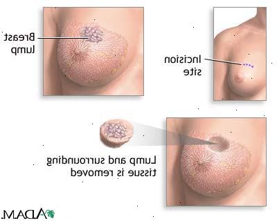 Lumpectomy. Slutt å ta aspirin eller andre blodfortynnende medisiner. Lumpectomy. Slutt å ta aspirin eller andre blodfortynnende medisiner.
