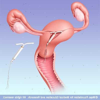 Levonova (hormonell spiral). I løpet av prosedyren. Levonova (hormonell spiral). I løpet av prosedyren.