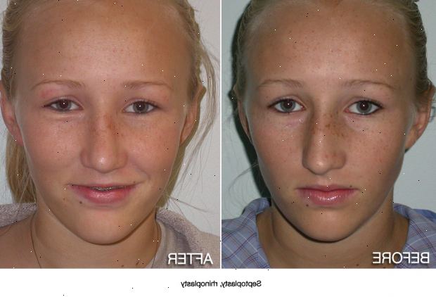 Septoplasty. Din medisinske historie. Septoplasty. Din medisinske historie.