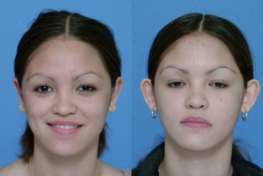 Otoplasty. Asymmetri i øret plassering. Otoplasty. Asymmetri i øret plassering.