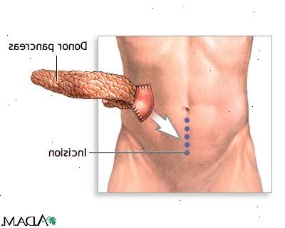 Pancreas transplantasjon. Komplikasjoner av prosedyren. Pancreas transplantasjon. Komplikasjoner av prosedyren.
