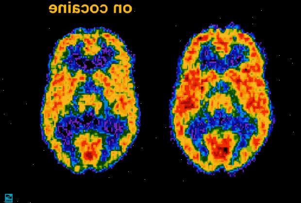 Positronemisjonstomografi (PET) scan. Kreft. Positronemisjonstomografi (PET) scan. Kreft.
