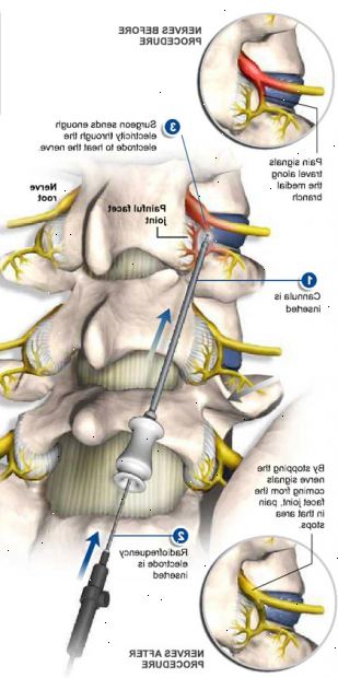 Radiofrekvens neurotomy. Definisjon. Radiofrekvens neurotomy. Definisjon.