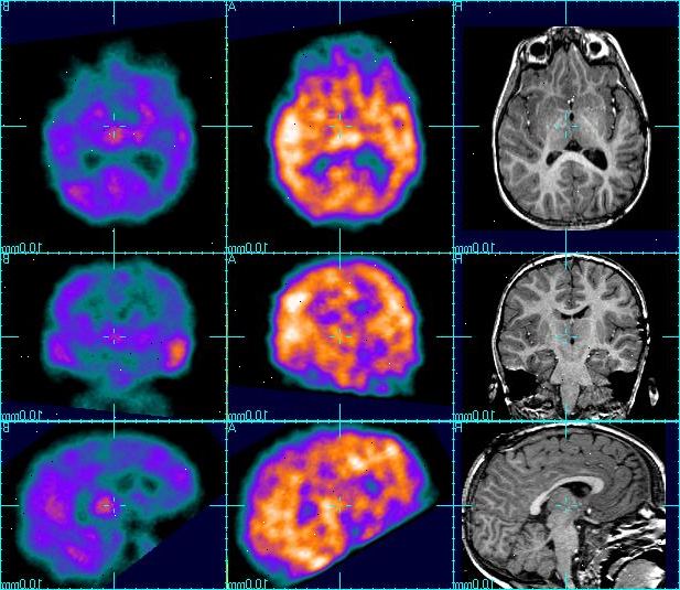 SPECT scan. Tett koronararteriene. SPECT scan. Tett koronararteriene.